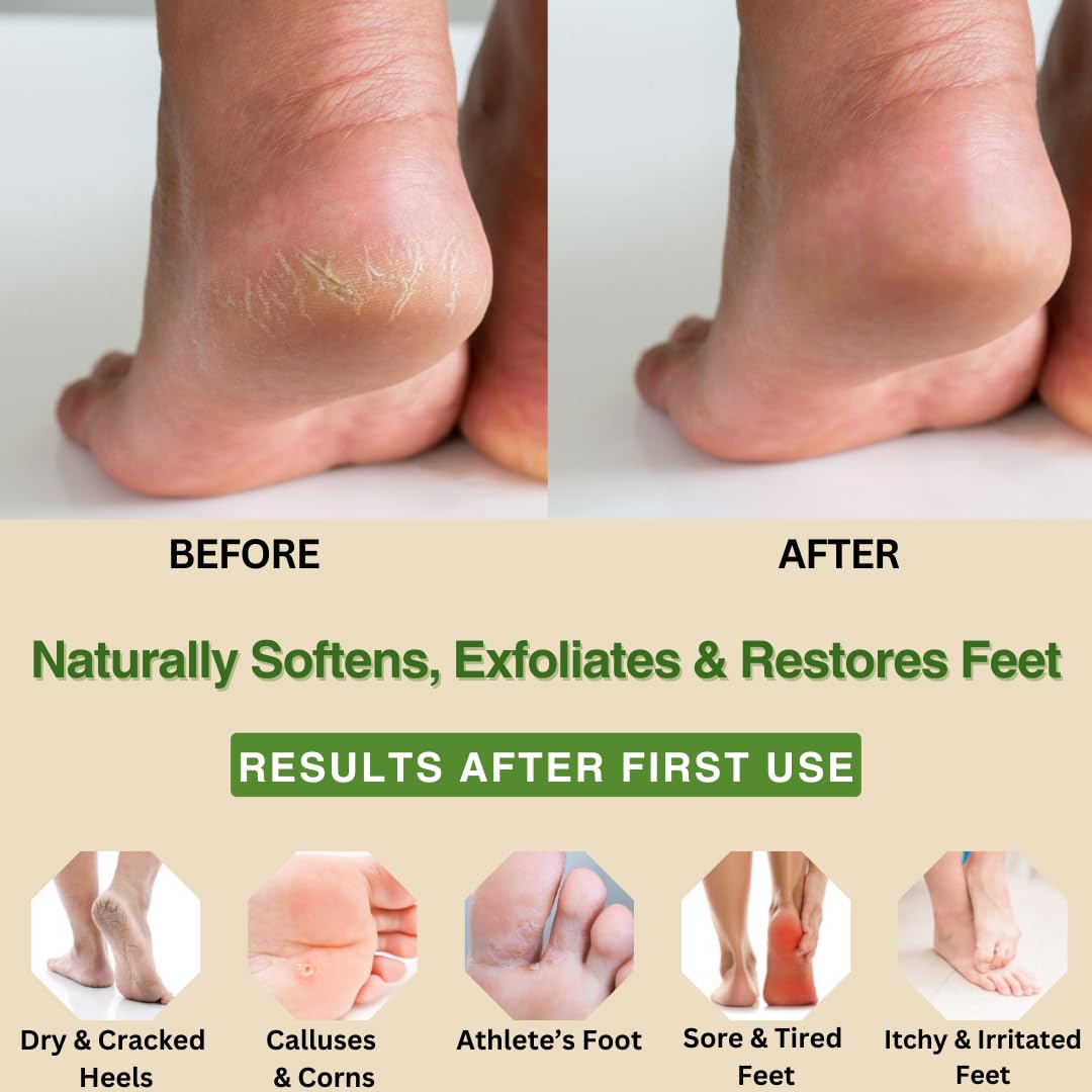 UniSonym Peppermint + Rosemary, Eucalyptus & Tea Tree Foot Cream for Dry Cracked Heels and Feet - Moisturizing Foot Lotion for Cracked Heel Repair - Callus Remover with Lactic Acid (4 oz)